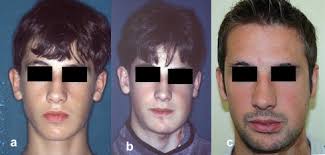 Microvascular reconstruction of mandibular defects in paediatric patients