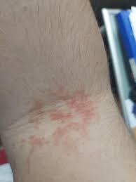 Oft stellt sich aber die gewünschte besserung nicht ein und nicht. Komische Ekzeme Am Arm Ekzem