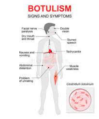 Botulism is a rare but potentially fatal illness caused by a toxin produced by the bacteria clostridium botulinum.the illness targets your nervous system and can lead to paralysis and respiratory. Wat Is Botulisme Gaaf Injectables