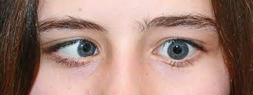 Schielen Auge Online
