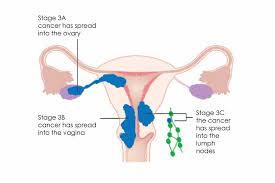Disciples of mockery was laid to rest in 1999 and womb reunited in 2002. Womb Cancer Treating Womb Cancer