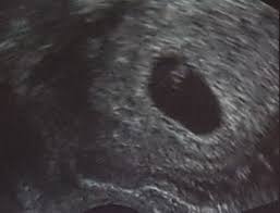 Ultraschallbilder Mehr Als 50 Bilder Aus Der Schwangerschaft Faminino