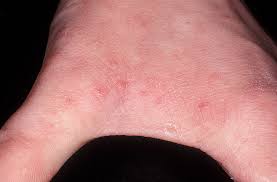 While these medications kill mites quickly, the itching may last for several weeks. Kultup Scabies Dokterkulitku