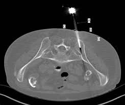 Image result for Bone Marrow Exam