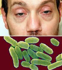 When left untreated, the toxin reaches the respiratory muscles resulting in lung failure. Botulism Symptoms Causes And Home Remedies