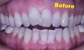 Maybe you would like to learn more about one of these? What Is An Open Bite Rector Orthodontics