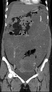 The benign cystic mesothelioma of the peritoneum is a rare lesion and is known for local recurrence. 28year Old Female With Malignant Peritoneal Mesothelioma Coronal Download Scientific Diagram