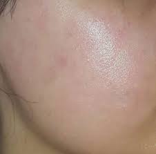 Eventuell ist eine zweite reaktion nach 4 bis 6 stunden möglich (verzögerte sofortreaktion). Gesicht Total Rot Und Brennt Allergische Reaktion Oder Nur Hautirritation Siehe Bild Gesundheit Und Medizin Gesundheit Haut