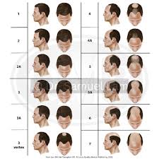 Image result for Alopecia