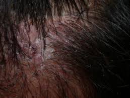 Scalp folliculitis is a skin condition where the hair follicles on the scalp become inflamed or irritated. Folliculitis Decalvans Dermnet Nz
