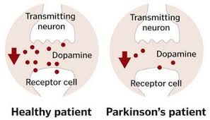 This will include elective procedures for the treatment of parkinson's disease (pd). Cryotherapy May Prevent Treat Parkinson S Disease