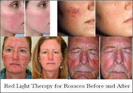Red Light Therapy Reduce Wrinkles Age Spots Acne More Light Therapy Red Light Therapy Led Light Therapy