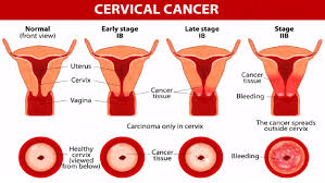 If you have an abnormal pap smear, it is extremely important that you follow up on recommendations from your doctor, whether that be a. Everything You Need To Know About Cervical Cancer Health Guide 911