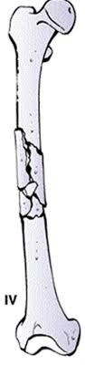 Prof nabile ebraheim, university of toledo, ohio, usa. Femoral Shaft Fractures Trauma Orthobullets