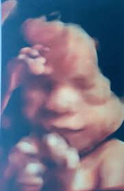 Can A 3d Ultrasound Detect Fas April 2020 Babies Forums What To Expect