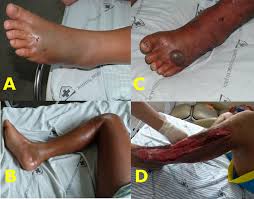 A venomous (poisonous) snake bite is a bite or a puncture wound made by a snake that is capable of injecting, secreting, or spitting venom into the penetrated skin wound. Evolution Of Bothrops Snakebite Wounds In This Study A Foot With Download Scientific Diagram