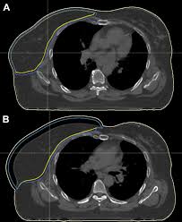 But hearing the words can still be scary. Using Robust Optimization For Skin Flashing In Intensity Modulated Radiation Therapy For Breast Cancer Treatment A Feasibility Study Practical Radiation Oncology