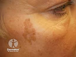 Image result for Solar Lentigo