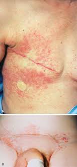 It also often results in an enlarged thyroid. Dermatologic Signs Of Systemic Disease