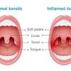 Most of the throat cancer starts in the pharynx, the tube that starts behind your nose and ends in your neck. 1