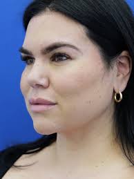 Cases in Chin/Neck Liposuction