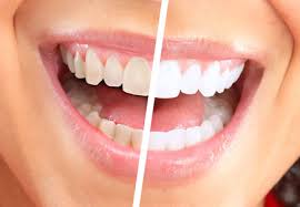 Laser Whitening Is Fast And Can Make You More Attractive Lunada Bay Dental Practice Palos Verdes Estates California
