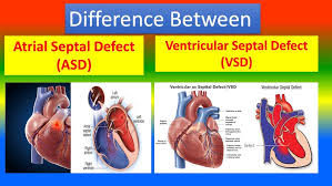 Image result for Ventricular Septal Defect