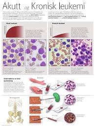 Aml er en kreftform forårsaket av ukontrollert vekst av myeloblaster. Akutt Og Kronisk Leukemi Pdf