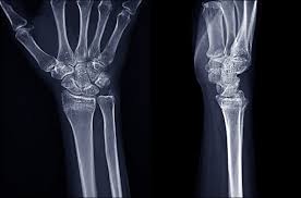 Image result for Wrist XRay