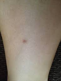 By definition, an ingrown hair is just a hair that is doing its job by growing, but is obstructed by clogged pores. Ingrown Hair On Leg Help Beautylish