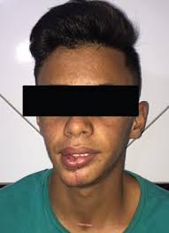 Intraosseous Mucoepidermoid Carcinoma in the Mandible