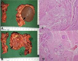 They contain three cellular elements in varying proportions: Recurrent Mucoepidermoid Carcinoma Of Parotid With Facial Tics Report Of An Unusual Case