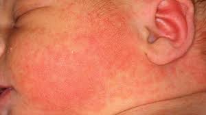 Simply pat your baby's skin dry. Baby Acne Causes Symptoms And Treatment