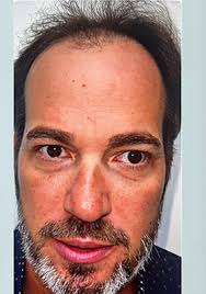 Hair Restoration Techniques For Men And Women in California Sonoma Bodega