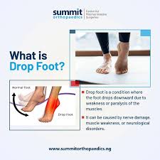 Image result for Foot Drop