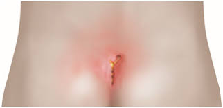 This sinus may cause problems for people if a pilonidal cyst forms on the area. Pilonidal Sinus Surgery Parkside Hospital