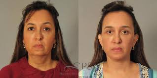 Facelift in Houston, TX