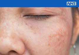 Breast cancer is the second most common cancer found in women — after skin cancer — but that doesn't mean men aren't at risk as well. Nhs On Twitter If You Have Lots Of Moles Or Freckles Your Risk Of Getting Skin Cancer Is Higher Than Average So Take Extra Care Https T Co N5nxebinyn Skincancerawarenessmonth Https T Co O0hxs04kml