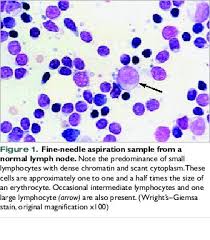 Acute onset with marked symptoms from the beginning of the disease 2. Cytodiagnosis Of Feline Lymphoma Vetfolio