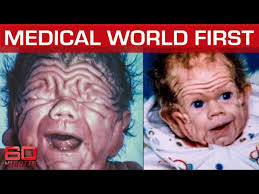 Conjoined babies abandoned by drug addict mum