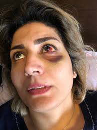 Regina couple injured in deck collapse wants builder, developer to take  responsibility