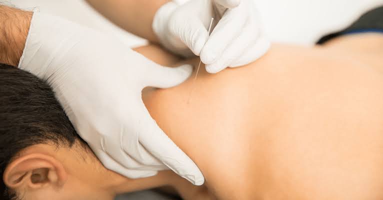 Dry Needling Services in Dubai - Korehab Clinic - Orthopedic Surgery,  Physiotherapy & Rehabilitation, Dubai