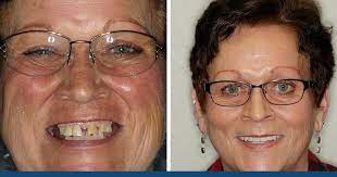 Check spelling or type a new query. How Much Do Dentures Cost Aesthetic Dental Center 701 214 5552