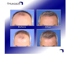 Dr Cam Simmons Early Growth At 5 Months After 3112 Grafts Transplanted In Front This Patient In His Early 50 S Ha Salt And Pepper Hair Hair Transplant Hair