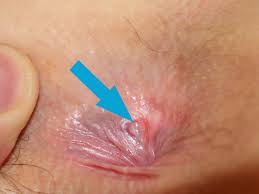 Bump on the anus: 7 causes and their treatments