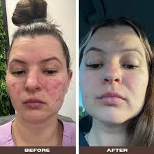 Did anyone use red light therapy for healing?