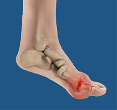 Image result for gout