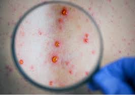 Diese bilder helfen dabei, die anzeichen zu deuten und erkrankungen im mund zu erkennen. Windpocken Hautausschlag Durch Varizella Zoster Virus