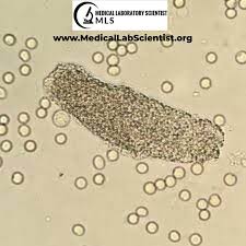 Image result for Urinary Cast