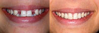 We did not find results for: Types Of Dental Implants Forestbrook Dental Markham Dentist Ontario